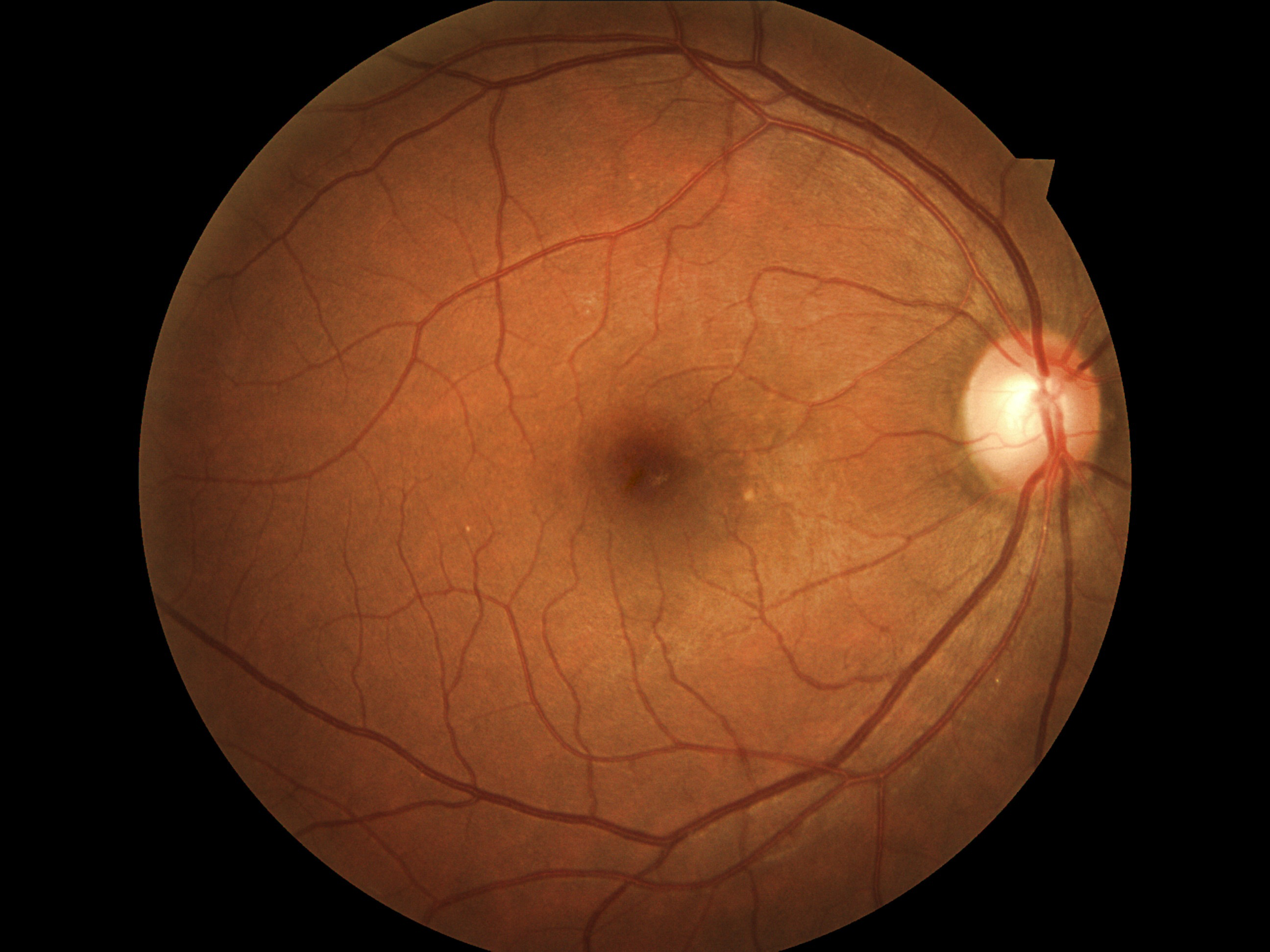 Right Eye Vessel Segmentation thumbnail