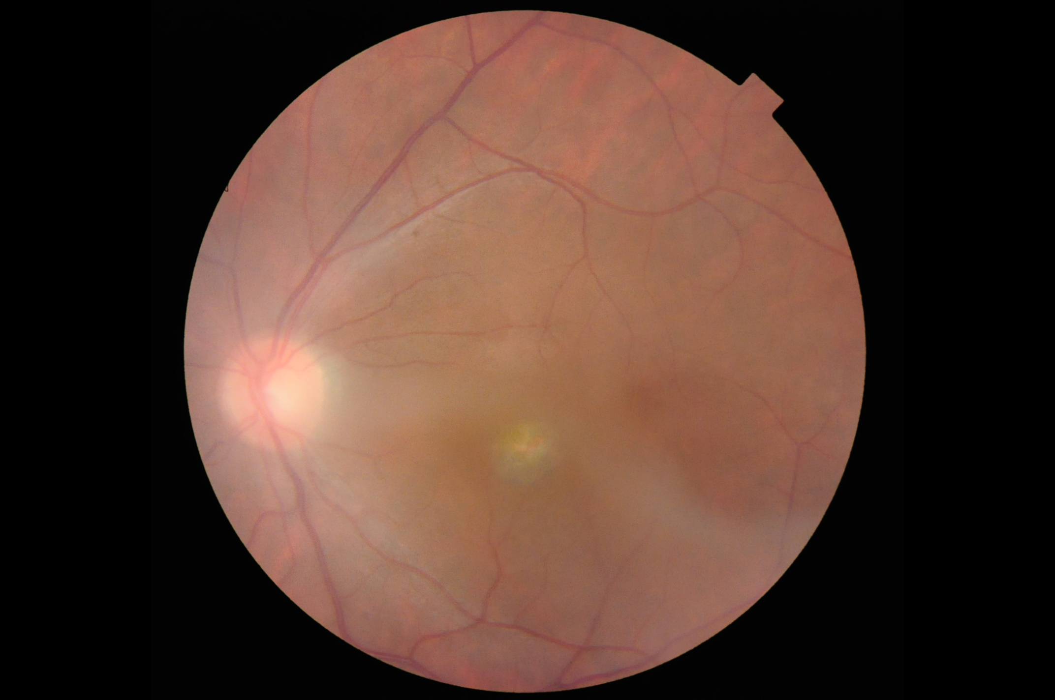 Low-Contrast Vessel Mask Example thumbnail
