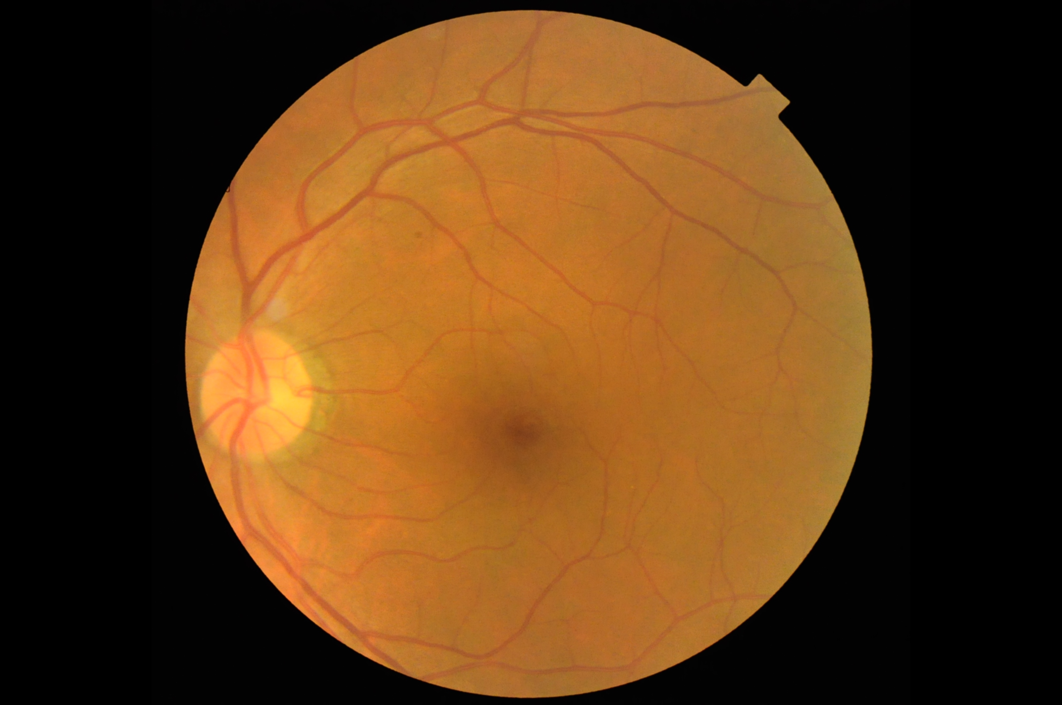 Retinal Vessel Output Sample thumbnail